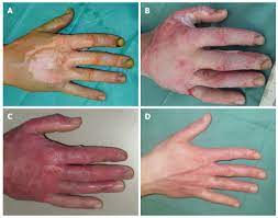 Eschara) is a slough or piece of dead tissue that is cast off from the surface of the skin, particularly after a burn injury, but also seen in gangrene, ulcer, fungal infections, necrotizing spider bite wounds, tick bites associated with spotted fevers, and exposure to cutaneous anthrax. State Of The Art In Enzymatic Debridement