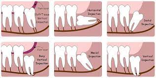 How do i know if i have wisdom teeth? Cost Of Removal Of Wisdom Teeth Uk