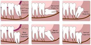 If the dentist sees an impacted wisdom tooth,. Where To Get Wisdom Teeth Removal In Birmingham Ascent Dental Care Solihull