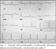 In most cases, the illness will pass without treatment. Scielo Brasil Forma Inusitada De Pericardite Cronica Constritiva Idiopatica Forma Inusitada De Pericardite Cronica Constritiva Idiopatica
