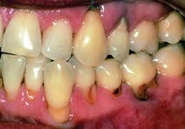 Photo Of Localised Recession Root Caries Visit Us At Gentle1 Com Dentist Teeth Dental Education Root Caries Dental Tooth Decay Remedies