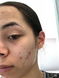 Maybe you would like to learn more about one of these? La Roche Posay Pigmentclar Serum Reviews Makeupalley