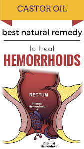 Hemoroide Interne Hemorrhoid Remedies Hemmoroids Treatment Hemorrhoid Relief