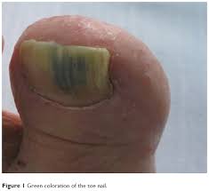 Nail fungus, also medically known as onychomycosis, is a chronic fungal infection of the fingernails and/or toenails by dermatophytes, also known as ringworm, yeasts and molds, leading to gradual destruction of the nail plate. Chloronychia Green Nail Syndrome Caused By Pseudomonas Aeruginos Cia