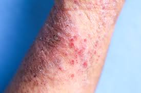 Image result for dermatitis contacta allergica
