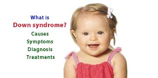 What Is Down Syndrome Causes Symptoms Diagnosis And Treatments