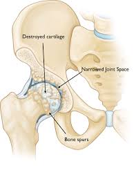 The pain can sometimes be see your gp if you or your child experiences persistent, severe or worsening bone pain, or if you're worried about any of the symptoms mentioned above. Hip Osteoarthritis Orthoinfo Aaos