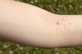 Because i am tuned into what i eat each day, i knew. Skin Rashes Types And Causes In Children