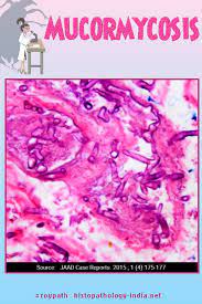 Rhizopus species are the most common causative organisms. Pathology Of Mucormycosis Pathology Histology Slides Squamous Cell Carcinoma