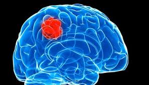 As the tumor grows, it creates pressure on and changes the function of surrounding brain tissue, which causes signs and symptoms such as headaches, nausea and balance problems. Brain Tumors In Children 8 Warning Signs You Should Know Johns Hopkins Medicine