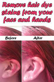Useful Ideas On How To Remove Hair Dye From Skin Alldaychic In 2021 Hair Dye Removal Dyed Hair How To Remove Hair Dye