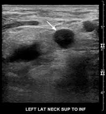 Each case is different and your doctor will explain your treatment options. Chapter 5 Ultrasound Characteristics Of Benign Vs Malignant Cervical Lymph Nodes Sciencedirect