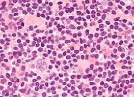 Nodular Lymphocyte Predominant Hodgkin Lymphoma Wikipedia