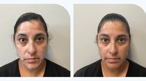 New Vitiligo Treatment Restores Skin Color, Patient's Confidence