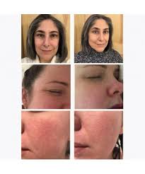 Mukti Face Dermaroller Beauty Face Tool Buy Online But how does dermarolling work? dermaroller