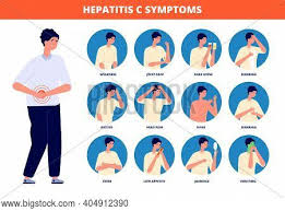Secondary liver cancer is more prevalent than primary liver cancer; Hepatitis C Symptoms Vector Photo Free Trial Bigstock