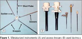During surgery, 2 to 4 small cuts surgical tools are put through other cuts. Figure 1 From Advantages Of Mini Laparoscopic Vs Conventional Laparoscopic Cholecystectomy Results Of A Prospective Randomized Trial Semantic Scholar