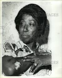 1979 Press Photo Mrs. Earlene Gaines Points to Lupus Rash