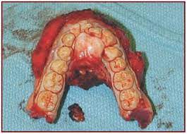 Hard palate cancer begins in the bony part on the roof of the mouth. Oral Cancer Caution May Be Disturbing Best Ogden Dentist