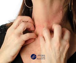 It is a skin disorder marked by inflamed skin patches, itchiness, and development of silvery scales. Stop The Itching Lyme And Hives Global Lyme Alliance