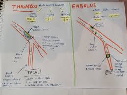 Difference Between A Thrombus And An Embolism Drawing Diagrams Is An Excellent Learning Tool I Would Have Failed Nursing If I Didn T Do This Nursing Nursin