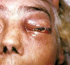Clinical presentation the presentation can vary, ranging from exophthalmos, rhinorrhea, and ophthalmoplegia. Mucormycosis Wikipedia
