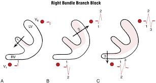 Image result for Right Bundle Branch Block