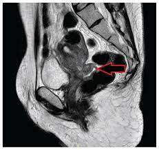 For the most part, cervical cancer can be prevented and cured when detected in the early stages. Locally Advanced Cervical Cancer In A Transgender Man Cmaj