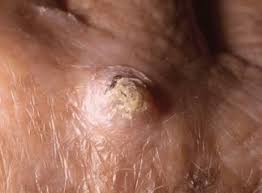 There are two main types of skin cancer: Squamous Cell Carcinoma Skin Disorders Msd Manual Consumer Version
