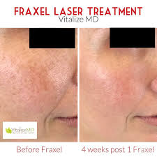 First, i want to ask him about fraxel laser to treat my acne scars. Fraxel Laser Treatment In Westborough Ma