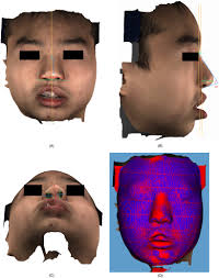 Three-Dimensional Analysis of Definitive Secondary Unilateral Cleft  Rhinoplasty Using Cartilage Graft