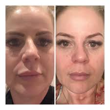 Esthetics With Emma Wrinkles & dryness? Not here 💫 These results are after  just ONE No-Tox Facial! This tightening + firming treatment is perfect if  you're looking to lift, brighten, and bring