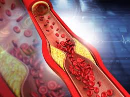 Clogged Arteries Symptoms: 7 Key Signs of Coronary Artery Blockage You  Shouldn't Ignore | TheHealthSite.com