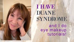 Duane's Syndrome