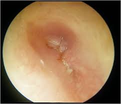 Image result for Acute Otitis Externa