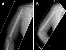 672 x 878 jpeg 69 кб. Recalcitrant Distal Humeral Non Union Following Previous Leiomyosarcoma Excision Treated With Retainment Of A Radiated Non Angiogenic Segment Augmented With 20 Cm Free Fibula Composite Graft A Case Report Abstract Europe Pmc