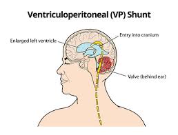 Vp Shunt In Singapore Costs Top Doctors Treatments And Hospitals Medigence