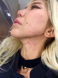 Yein said she broke up with her boyfriend before undergoing surgery recently. Dj Leng Yein Posts Horrific Photos Alleging Abuse At The Hands Of Her Boyfriend Over Two Years Coconuts Kl