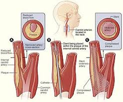 They split into the external and internal. Carotid Stenting Wikipedia