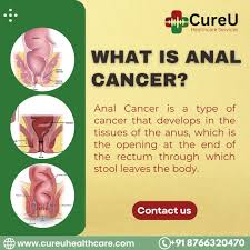Image result for Anal Cancer