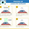 At tlc, we want to help you learn about the cost of lasik and how we can help make paying for lasik affordable. 1
