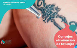 Consejos sobre la Eliminación de tatuajes lasersesion ...