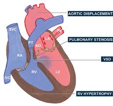 Tetralogy of fallot (tof) is a congenital heart defect which is classically understood to involve four anatomical abnormalities of the heart (although only three of them are always present). Jaypeedigital Ebook Reader
