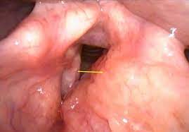 Throat cancer can develop in any part of the throat. Cureus Isolated Laryngeal Amyloidosis Mimicking Laryngeal Cancer