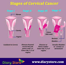 Pelvic pain or pressure is common for ovarian and uterine cancers. Cervical Cancer Cervical Cancer Symptoms Causes Treatment