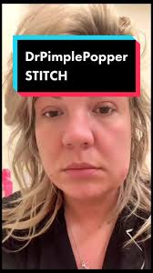 Identifying Spider Bites: Medical Expert's Insights