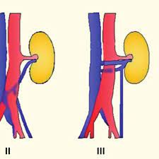 Types Of Left Renal Vein Anomalies Type I Retroaortic Left Renal Vein Download Scientific Diagram