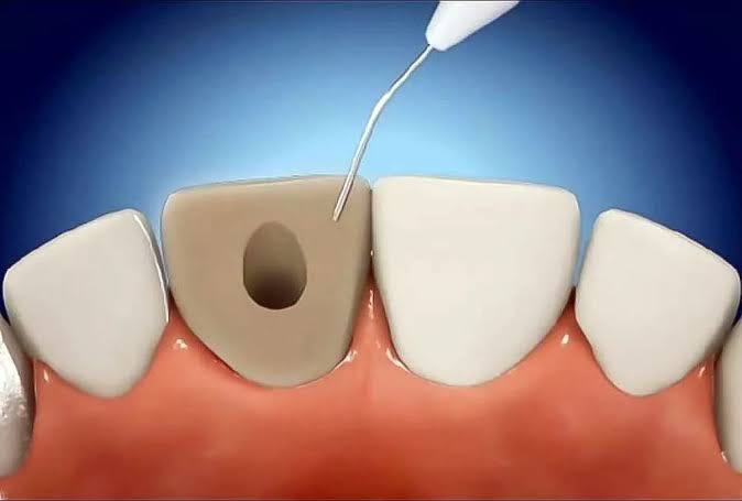 Internal Tooth Bleaching in Virginia Beach | Meares Becker