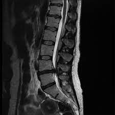 Cauda Equina Syndrome Implications For Primary Care British Journal Of General Practice