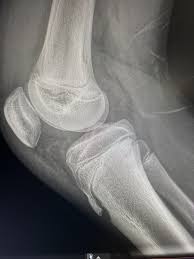 Image result for Knee XRay
